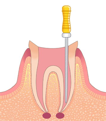 根管治療とは
