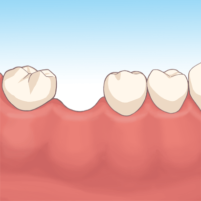 歯を失った状態を放置しておくリスク