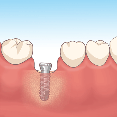 インプラントの埋め込み（一次手術）