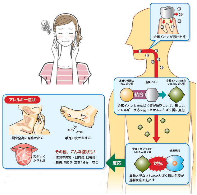 金属アレルギーのリスクとは？