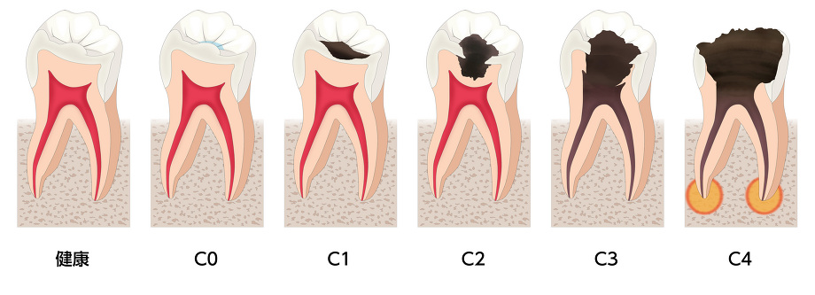 むし歯の進行