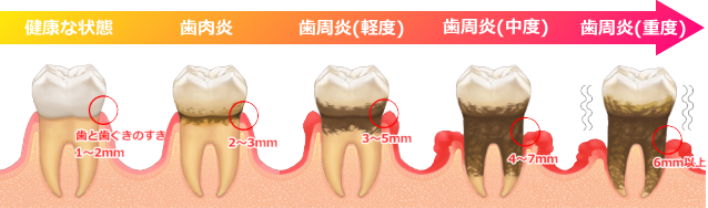 歯周病の進行