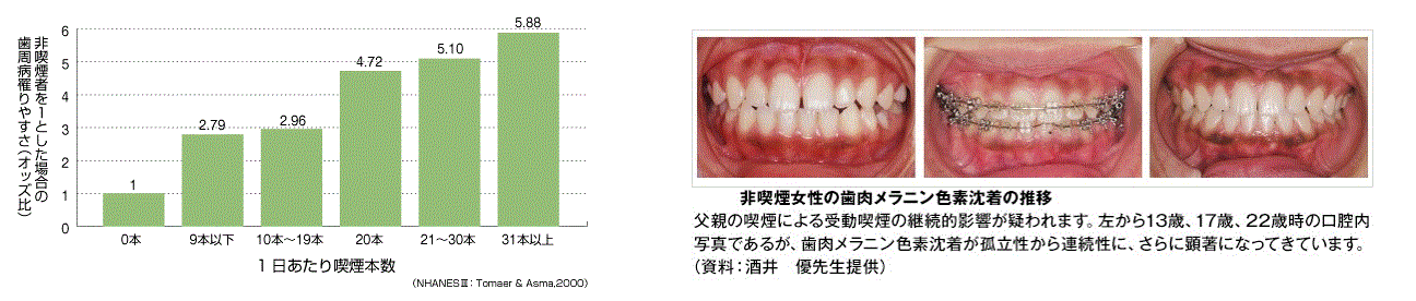 歯周病と喫煙