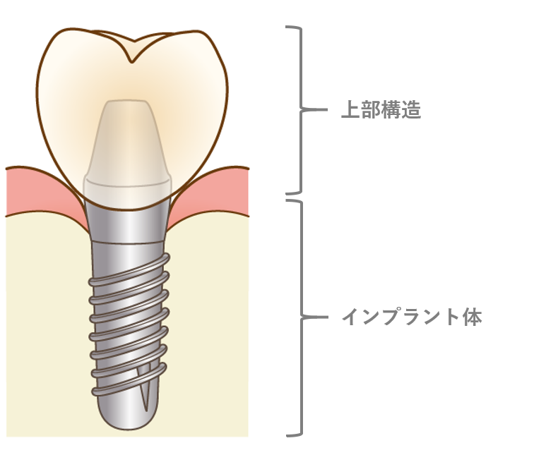 インプラント