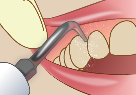 歯石の除去