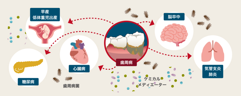 歯周病と全身疾患